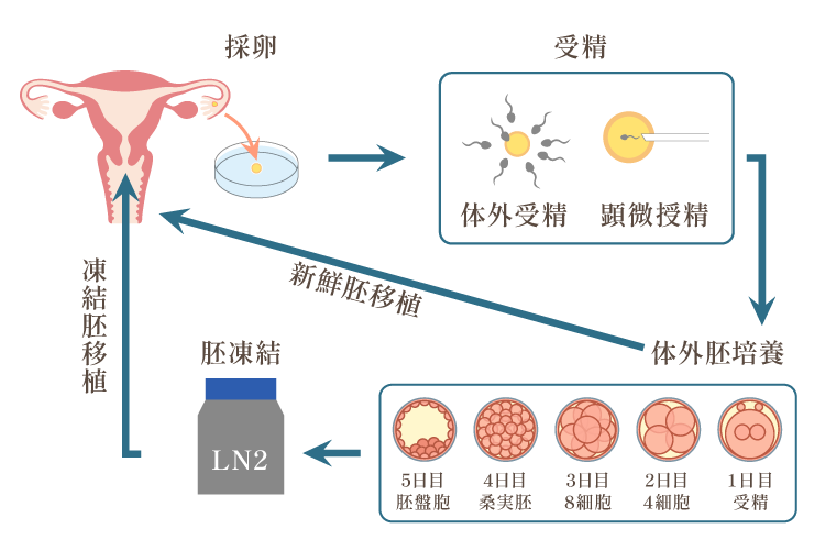 体外受精（IVF）のステップ