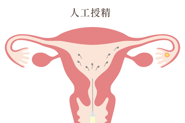 人工授精